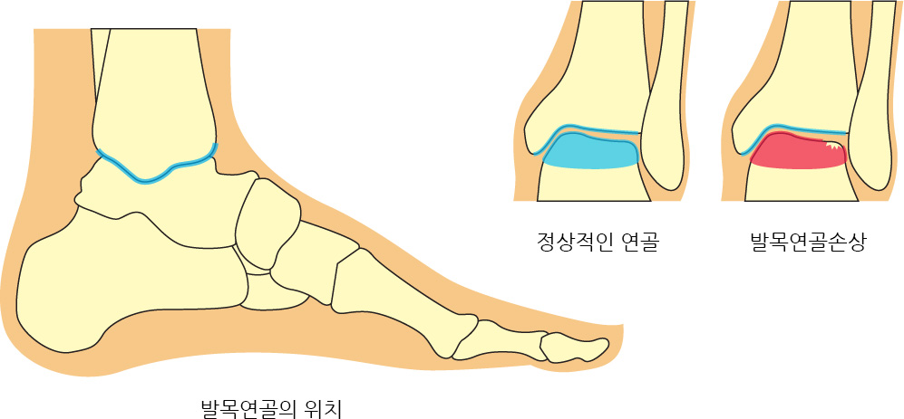 발목연골의 위치,정상적인 연골,발목연골손상