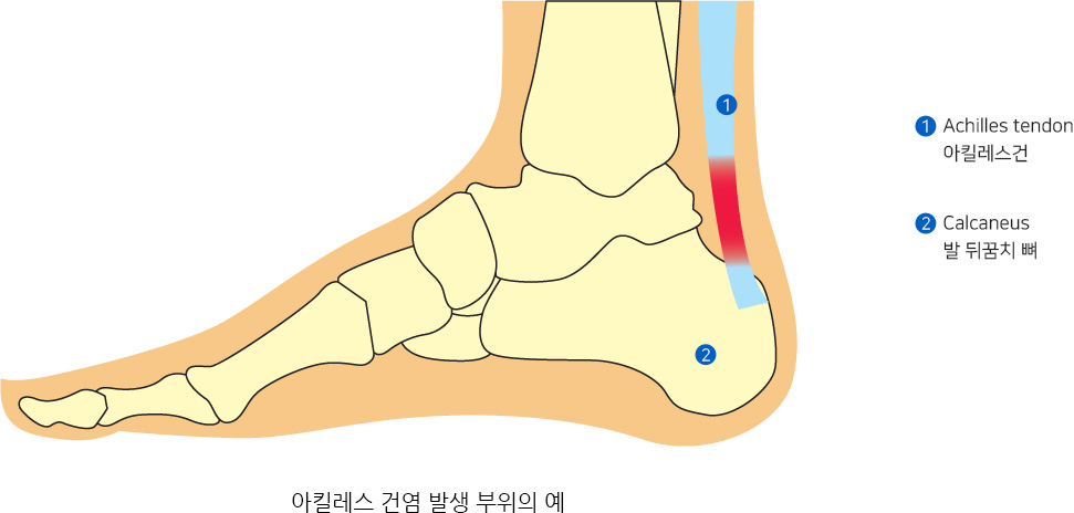 아킬레스 건염 발생 부위의 예,1:Achilles tendon 아킬레스건,2:Calcaneus 발 뒤꿈치 뼈