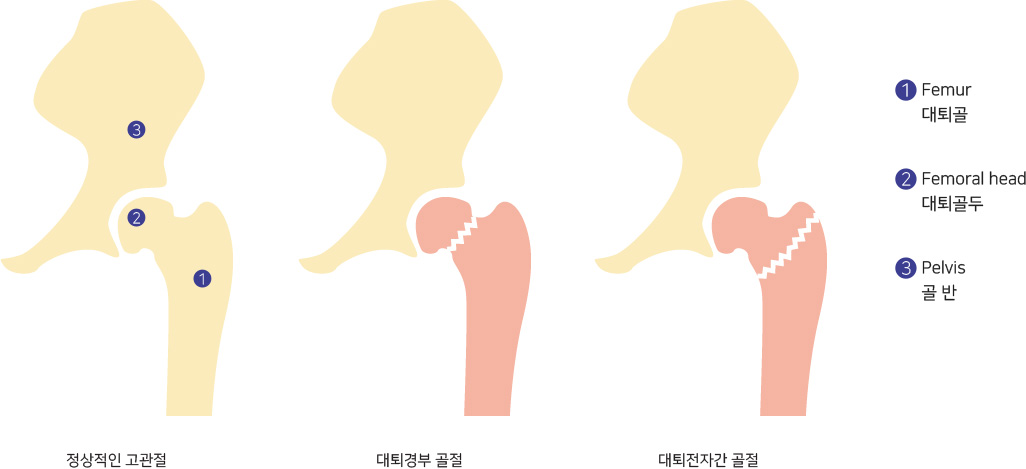 정상적인 고관절,대퇴경부 골절,대퇴전자간 골절,1:Femur 대퇴골,2:Femoral head 대퇴골두,3:Pelvis 골반