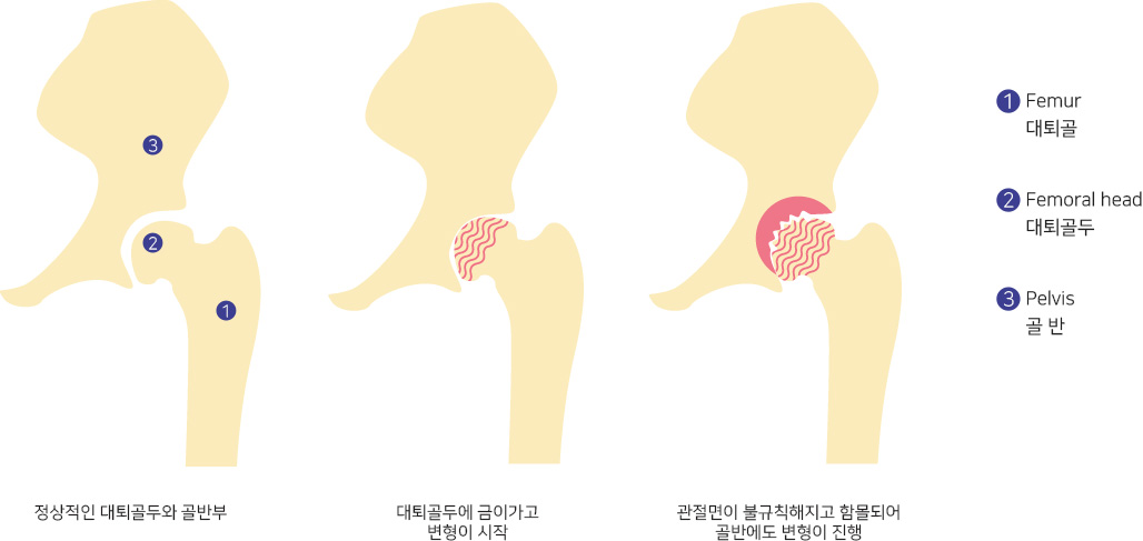 정상적인 대퇴골두와 골반부,대퇴골두에 금이가고 변형이 시작,관절면이 불규칙해지고 함몰되어 골반에도 변형이 진행,1:Femur 대퇴골,2:Femoral head 대퇴골두,3:Pelvis 골반