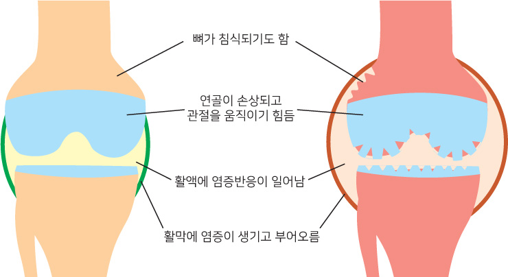 뼈가 침식되기도 함, 연골이 손상되고 관절을 움직이기힘듬, 활액에 염증반응이 일어남, 활막에 염증이 생기고 부어오름