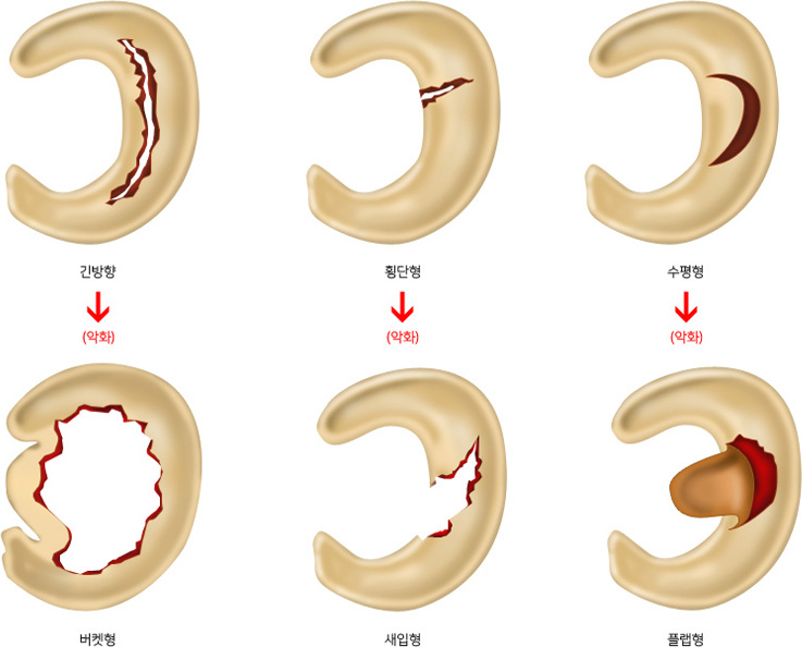 긴방향→악화→버켓형,횡단형→악화→새입형,수평형→악화→플랩형