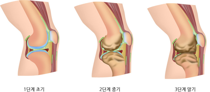 1단계 초기, 2단계 중기, 3단계 말기