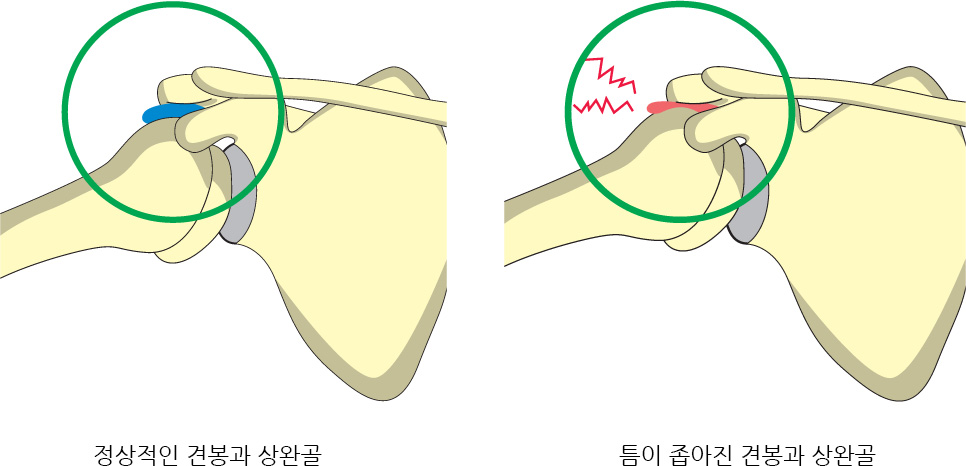 정상적인 견봉과 상완골,틈이 좁아진 견봉과 상완골 