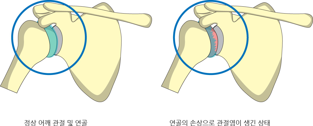 정상 어깨 관절 및 연골,연골의 손상으로 관절염이 생긴 상태