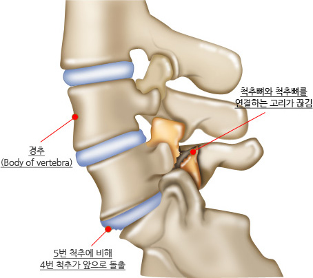 경추(Body of vertebra), 척추뼈와 척추뼈를 연결하는 고리가 끊김, 5번 척추에 비해 4번 척추가 앞으로 돌출